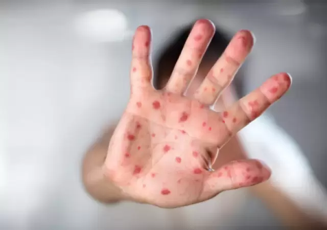 Lesiones t�picas de la viruela del mono.