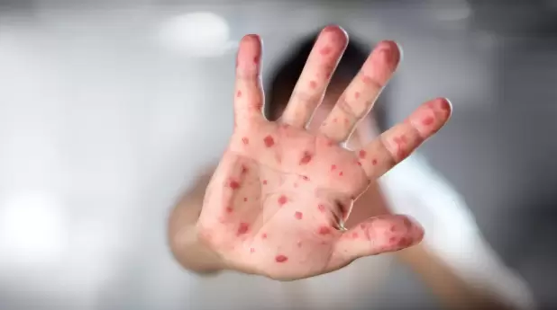 Lesiones t�picas de la viruela del mono.