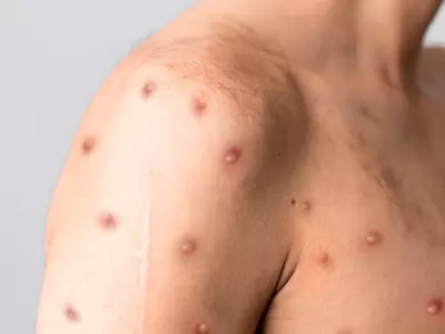 Los dos casos de Mpox se dan en un contexto de transmisi�n intrafamiliar.