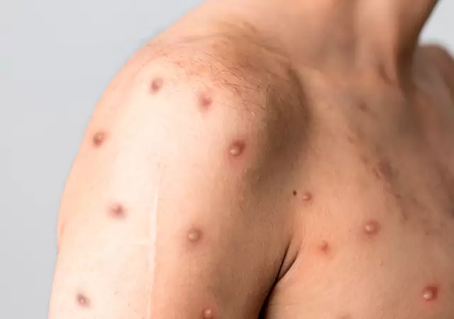 Los dos casos de Mpox se dan en un contexto de transmisi�n intrafamiliar.
