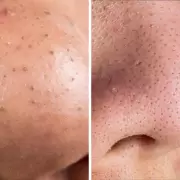 Manchas negras en el rostro: qu� son y por qu� no deber�as cerrarlas