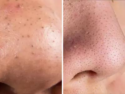 Gu�a para prevenir y tratar los puntos negros sin errores comunes.