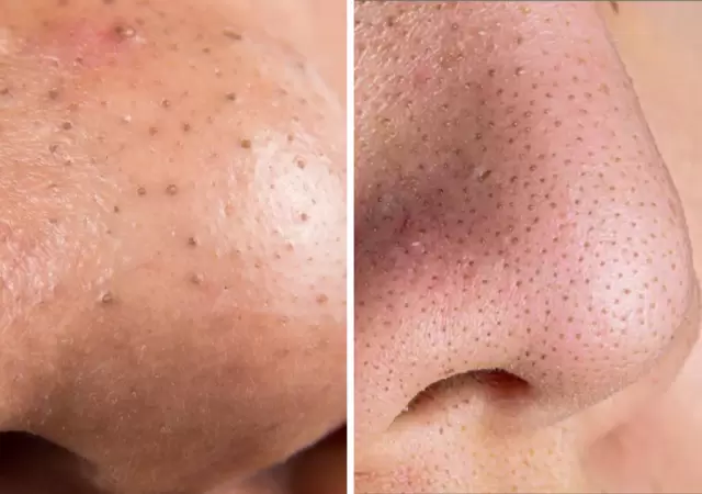 Gu�a para prevenir y tratar los puntos negros sin errores comunes.