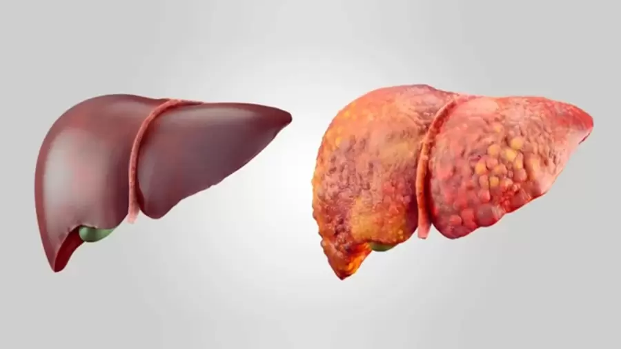 Diferencia entre un h�gado sano y uno graso.