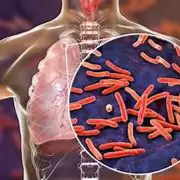 Los casos de tuberculosis aumentaron un 38% en Argentina y siembran preocupación