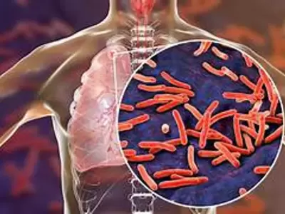 tuberculosis