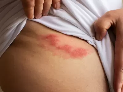 Herpes z�ster.