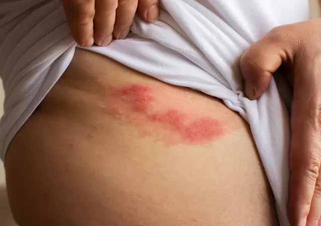 Herpes z�ster.