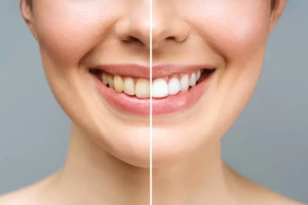 Dientes blancos.
