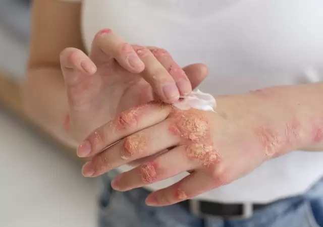 Se trata de una enfermedad de origen inmunol�gico, inflamatoria, cr�nica y sist�mica, que se manifiesta en la piel.