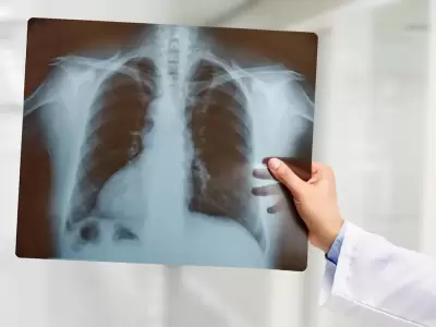 Un hombre sobrevivi� 48 horas sin pulmones