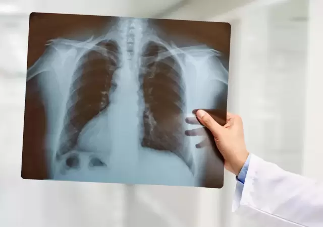Un hombre sobrevivi� 48 horas sin pulmones