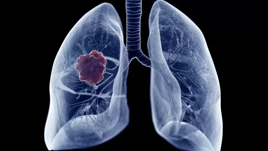 El c�ncer de pulm�n es una consecuencia de la contaminaci�n y el tabaco