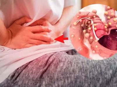 Onc�logos aseguran que el c�ncer de colon tiene 90% de posibilidad de cura con la detecci�n temprana y tratamiento.