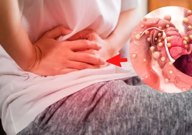 Onc�logos aseguran que el c�ncer de colon tiene 90% de posibilidad de cura con la detecci�n temprana y tratamiento.