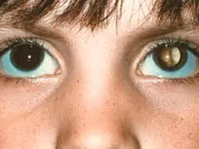 El flash de tu celular puede salvarle la vida: c�mo detectar el c�ncer ocular en ni�os con una foto.