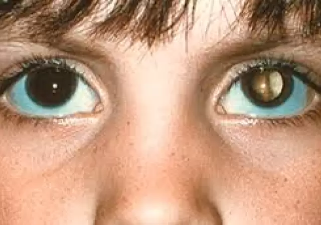 El flash de tu celular puede salvarle la vida: c�mo detectar el c�ncer ocular en ni�os con una foto.