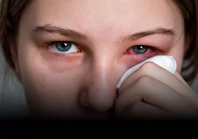 Qu� es la blefaritis y c�mo tratar esta molesta afecci�n.